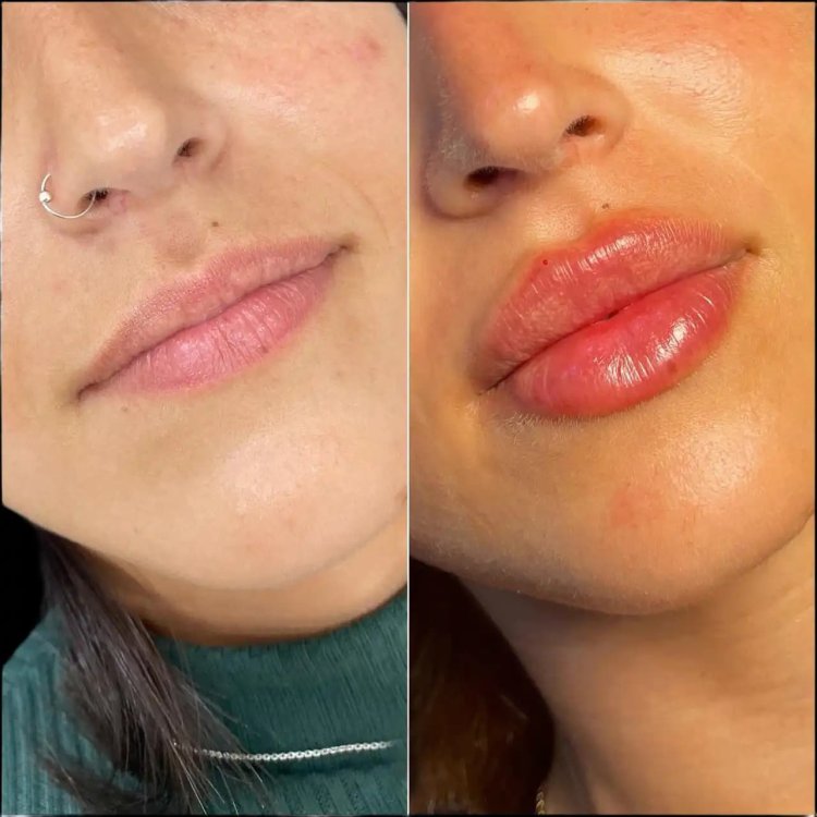 Natural Look with Lip Fillers Treatments in Dubai