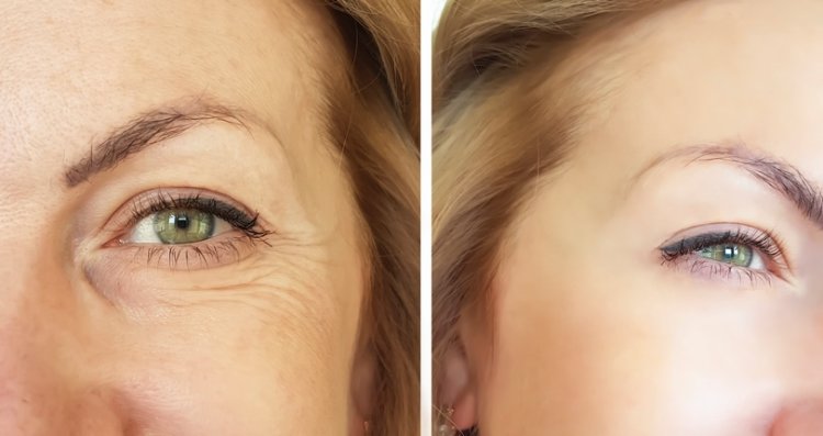 Blepharoplasty in Naples, FL: Restore a Youthful Appearance